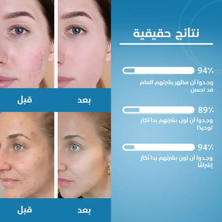 كريم مضاد لحب الشباب
